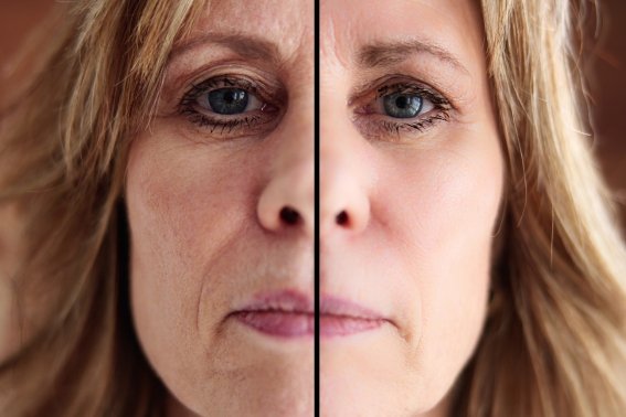 Preenchimento Facial - Passo Fundo - Dra. Carla Furlanetto
